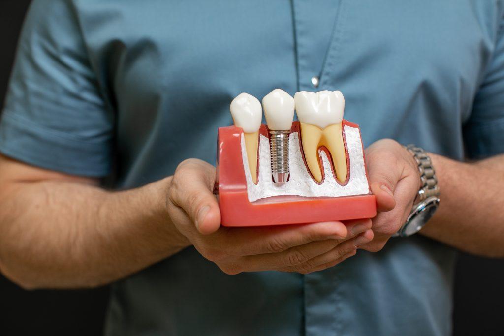 closeup-male-dentist-doctor-hands-with-dental-implant-model-as-teaching-aid-scaled