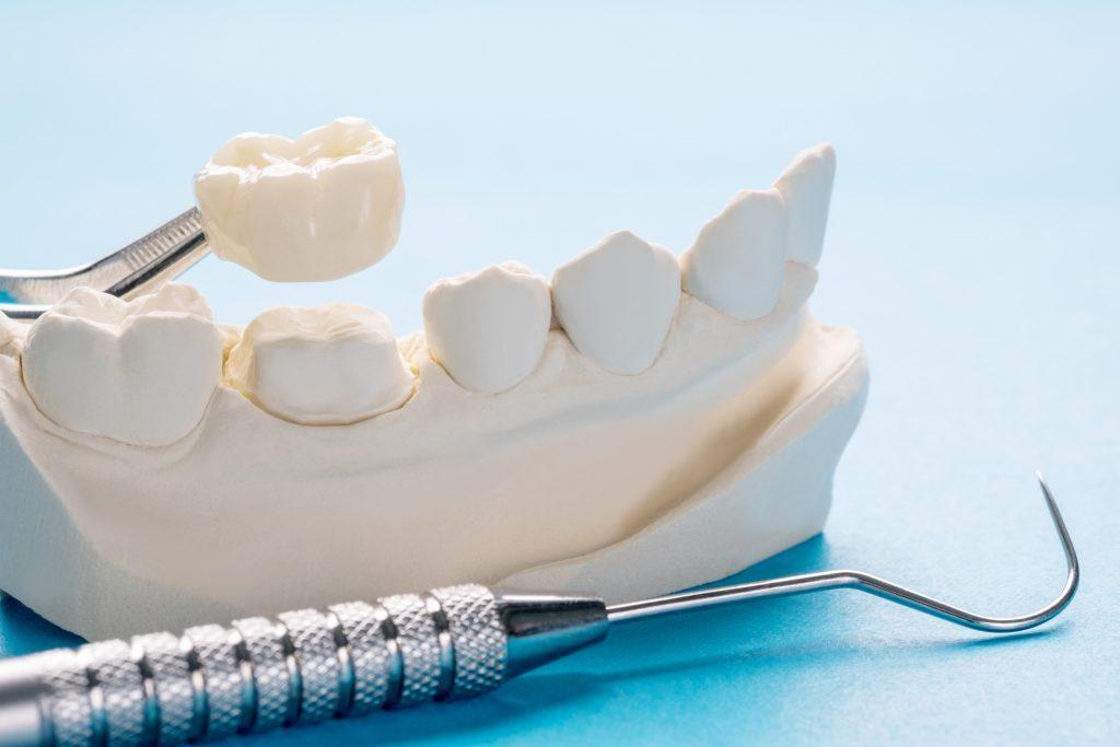 closeup-prosthodontics-prosthetic-single-teeth-crown-bridge-equipment-model-express-fix-restoration-scaled