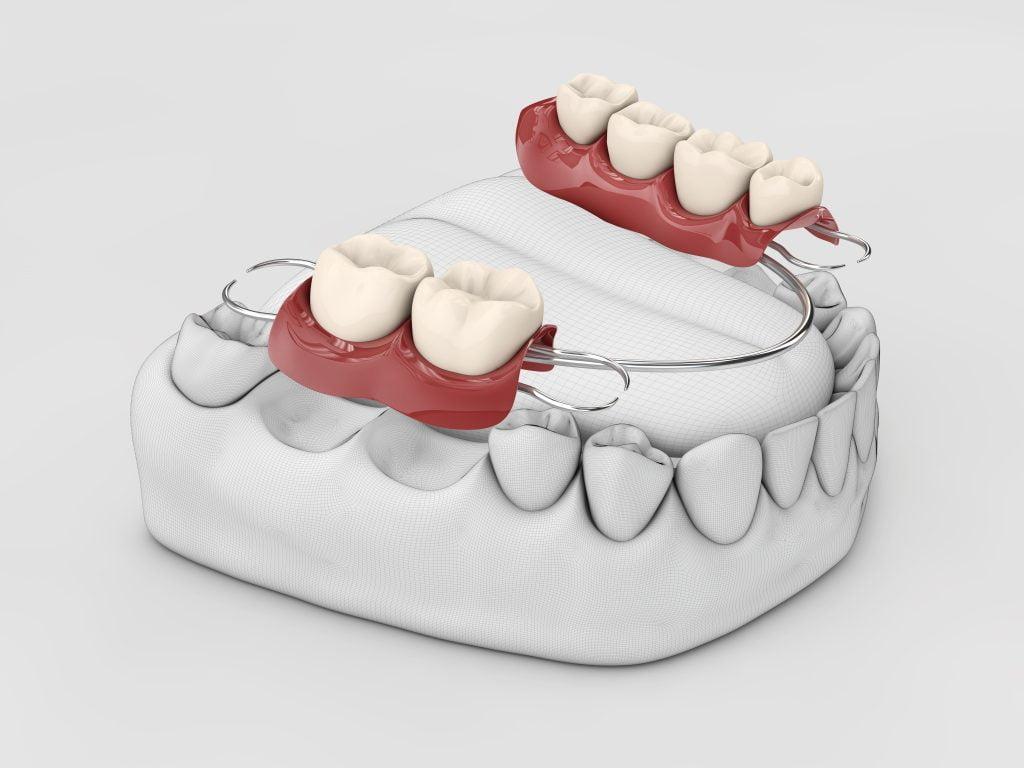 human-teeth-with-denture-3d-illustration-isolated-white-scaled