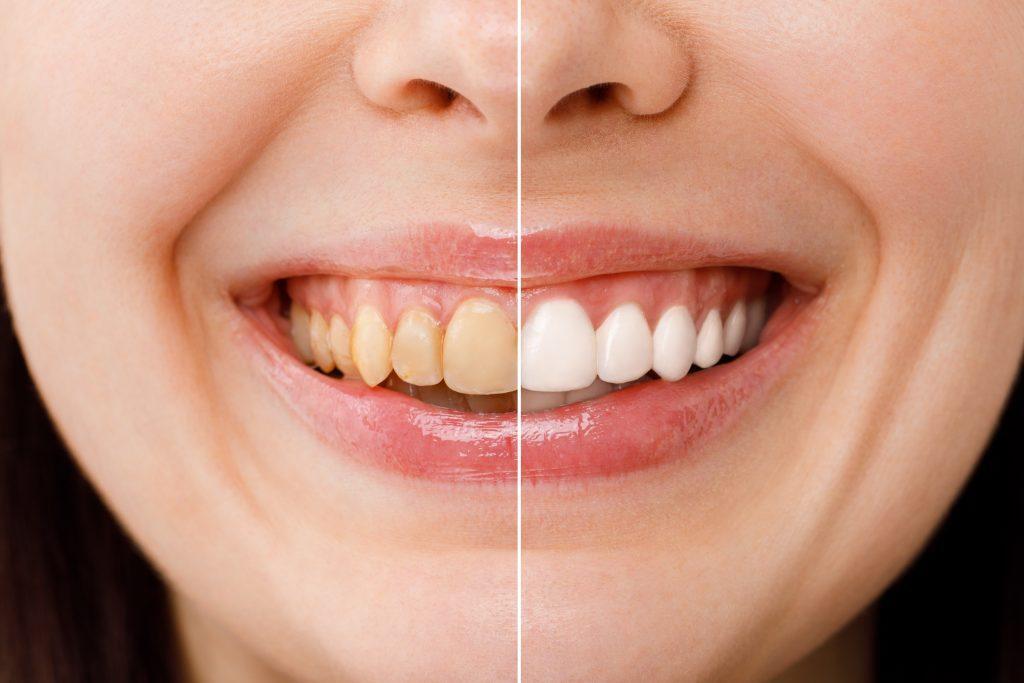 woman-teeth-before-after-whitening-white-background-dental-clinic-patient-image-symbolizes-oral-care-dentistry-stomatology-1-scaled
