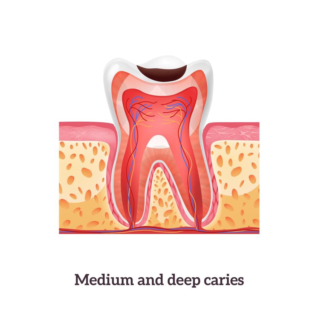 Gentle Tooth Extractions at Olive Branch Dental in Indianapolis