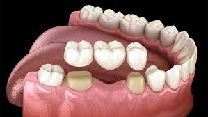 Dental Crowns