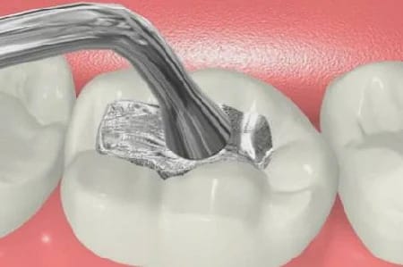 Dental Fillings