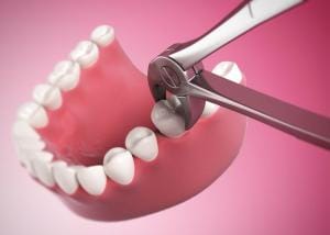 Tooth Extraction