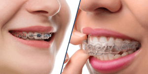 Clear Aligner Braces vs Traditional Braces