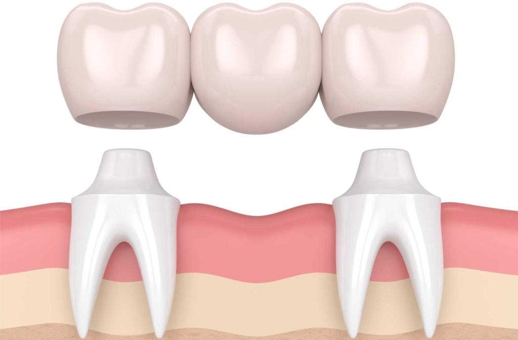 Dental Crowns in Olive Branch Indianapolis: Everything You Need to Know Before Getting One