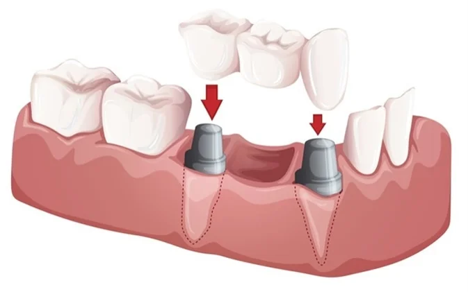 Bridges and Crowns at Olive Branch Indianapolis: Restoring Smiles with Strength and Style