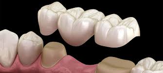 Dental Bridges in Olive Branch Indianapolis: A Complete Guide for Confident Smiles