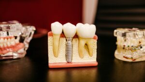 Dental implant model showing a titanium post and crown replacing a missing tooth