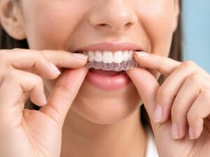 Woman placing clear aligners showing Invisalign tips for daily wear